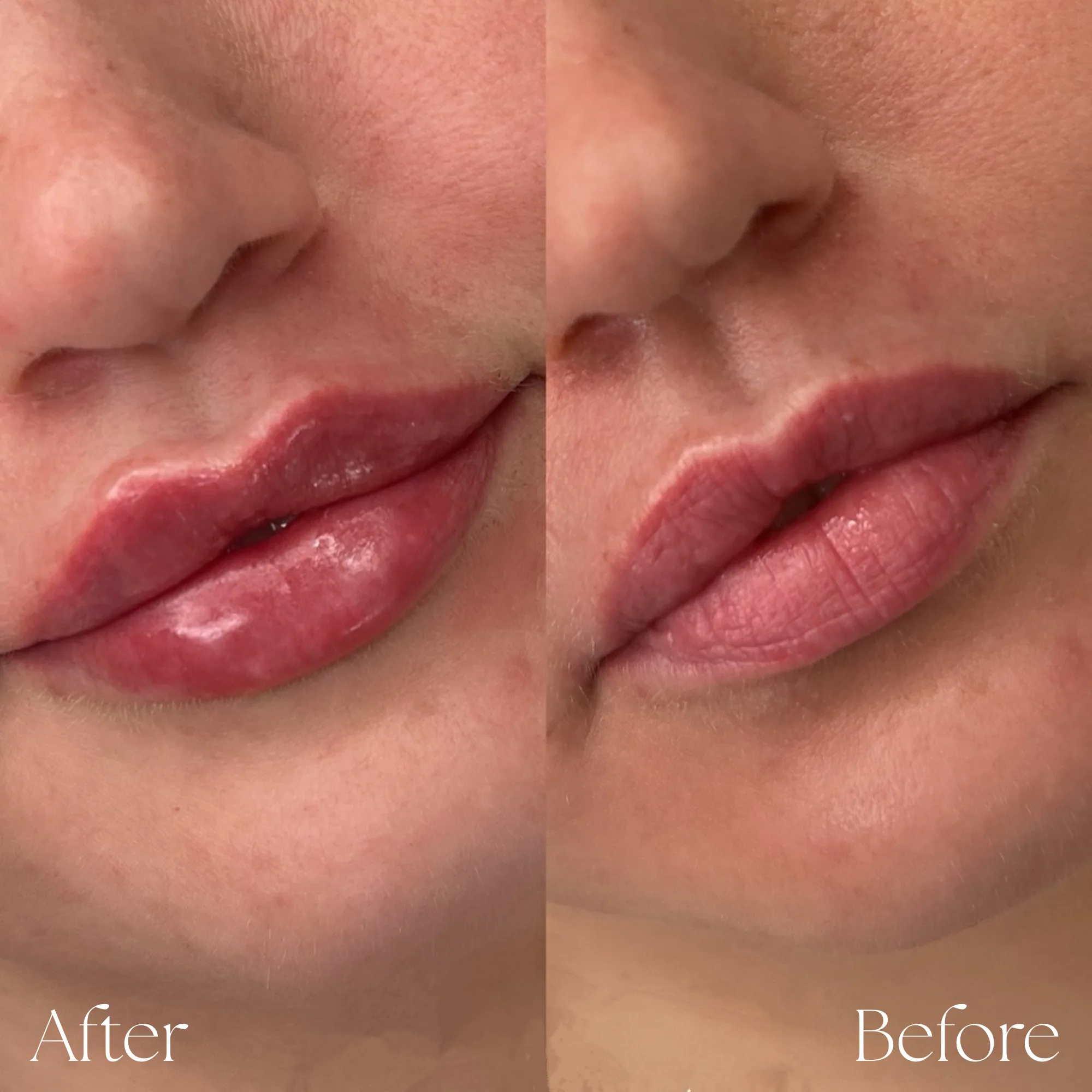 Lips Augmentation 12