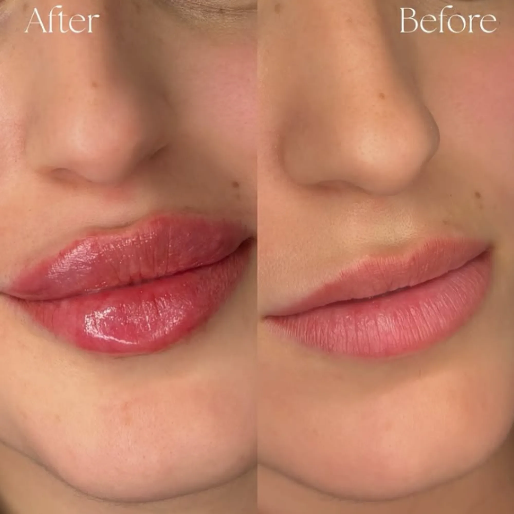 Lips Augmentation 8