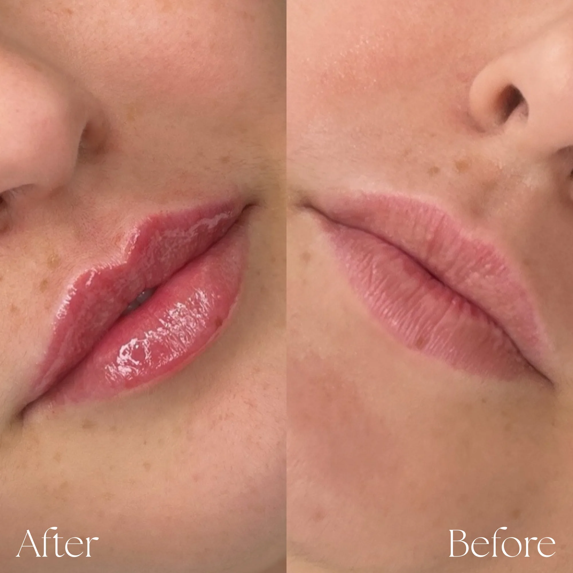Lips Augmentation 9