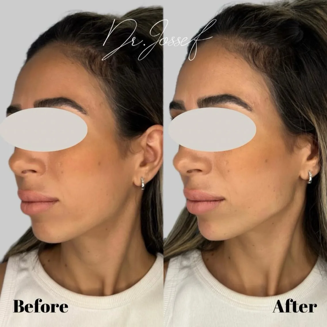 חידוד קו לסת 2