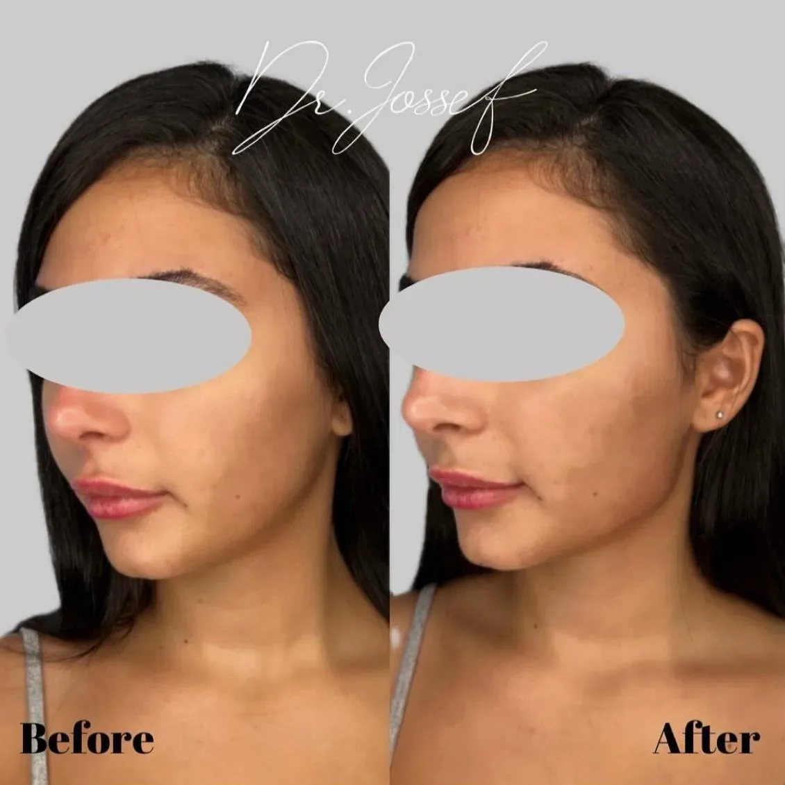 חידוד קו לסת