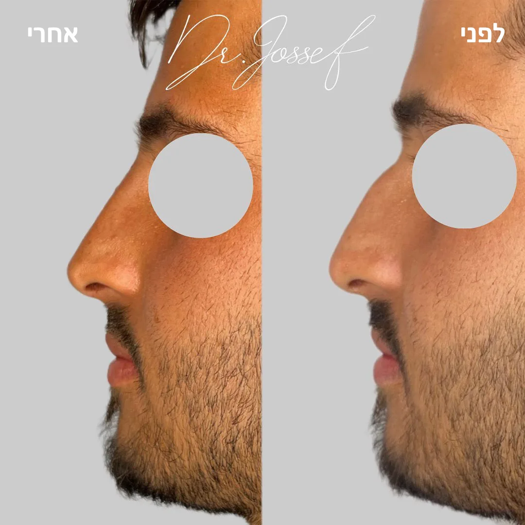 פיסול אף 3