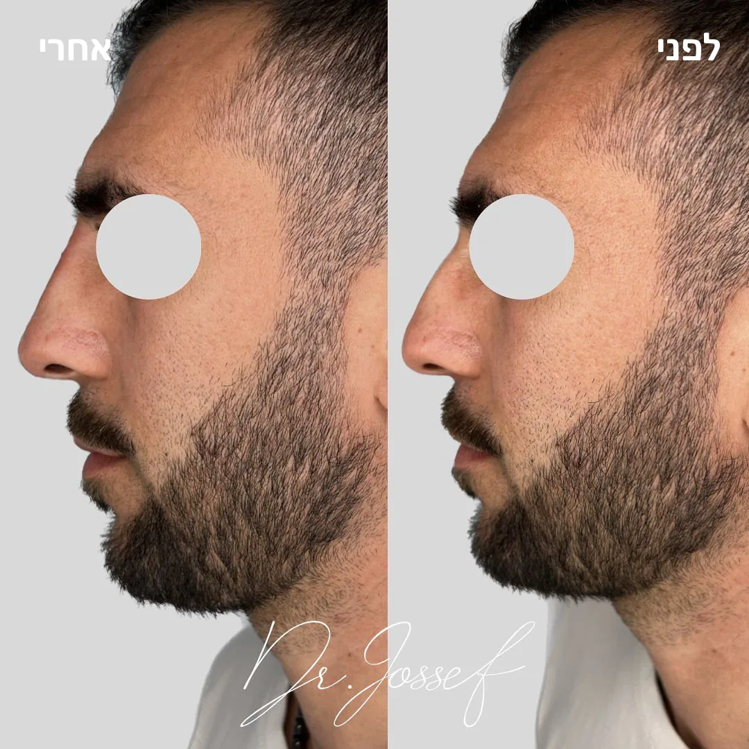 פיסול אף 5