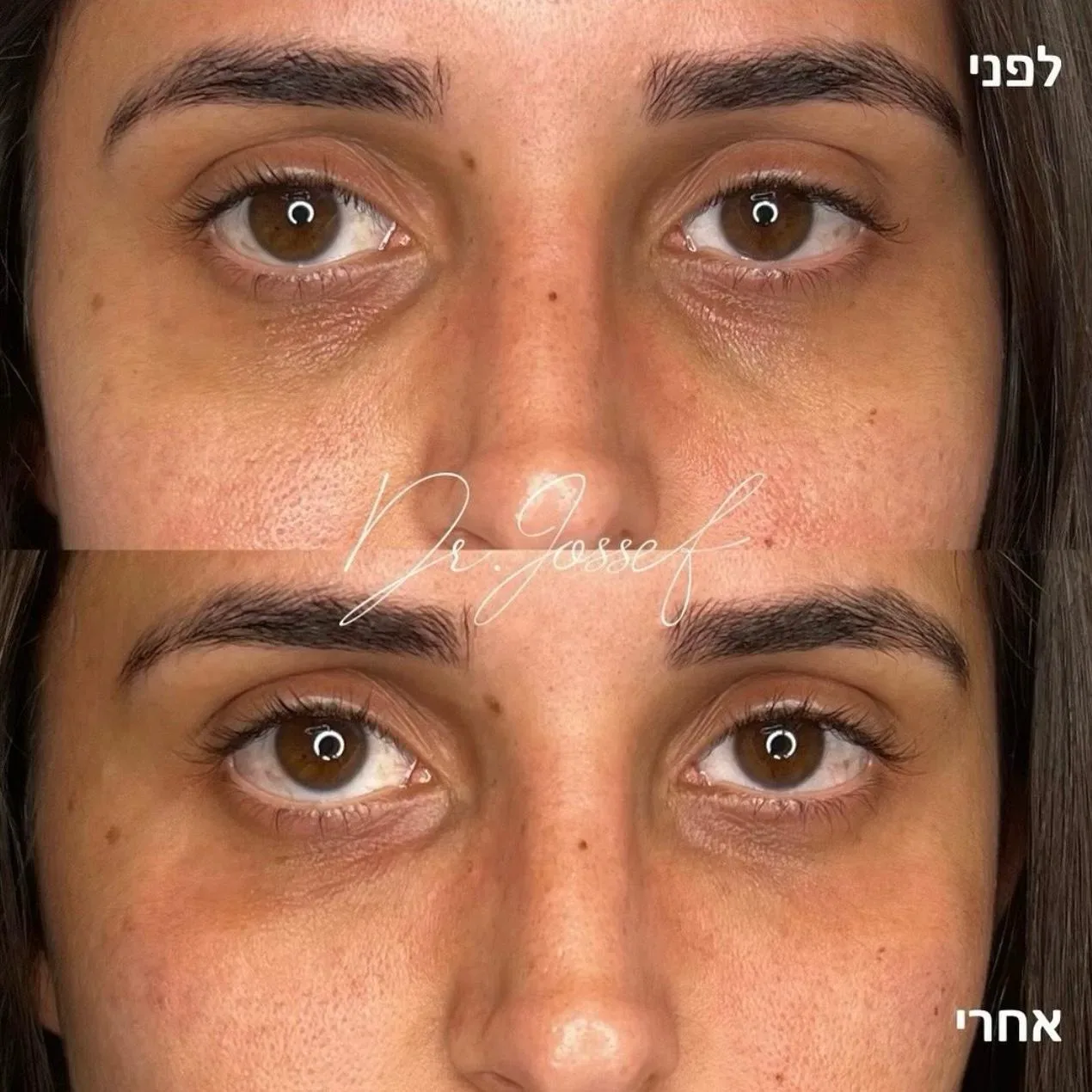 שקעי עיניים 7