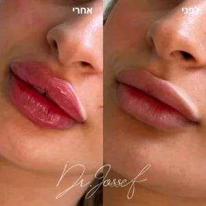 עיצוב שפתיים - ד״ר יאיר יוסף