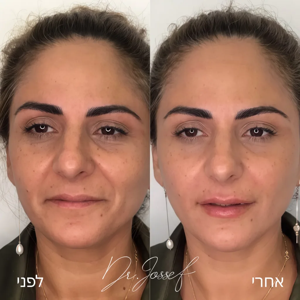 מילוי קמטים בצידי הפה לפני ואחרי